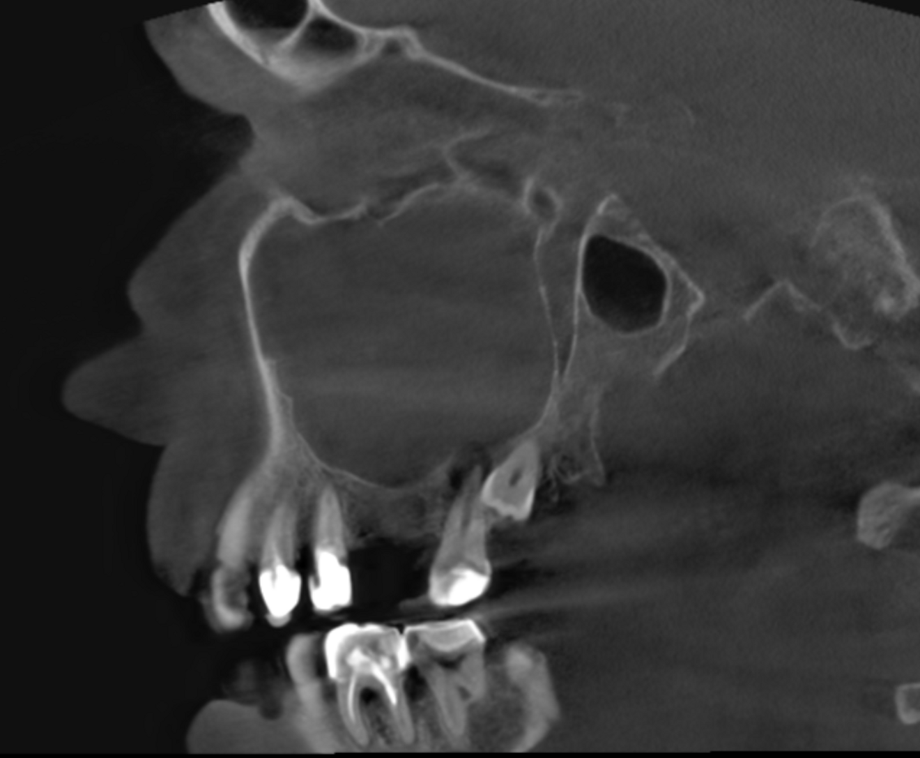 Fig. 2b: Large-volume CBCT scan, sagittal cross-section of the palatal root.
