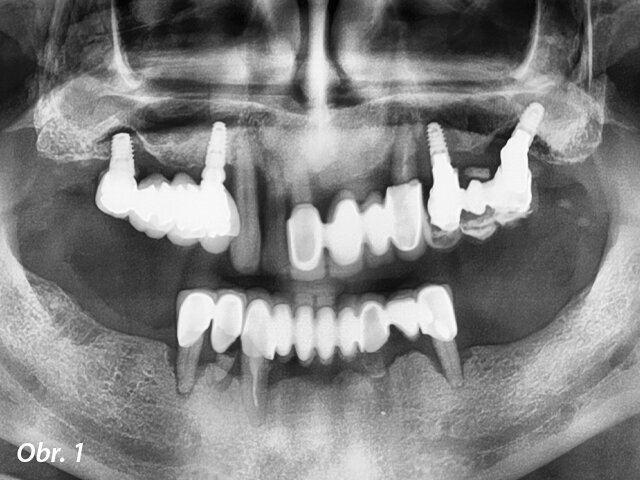 Panoramatický RTG snímek zubů pacienta. Je vidět pokročilá resorpce kosti.