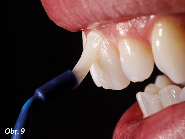 Obr. 9: Nanášení laku Profluorid Varnish k léčbě hypersenzitivity zubů