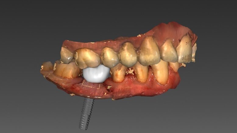 Cyfrowe techniki projektowania w estetycznych ostatecznych uzupełnieniach implantoprotetycznych