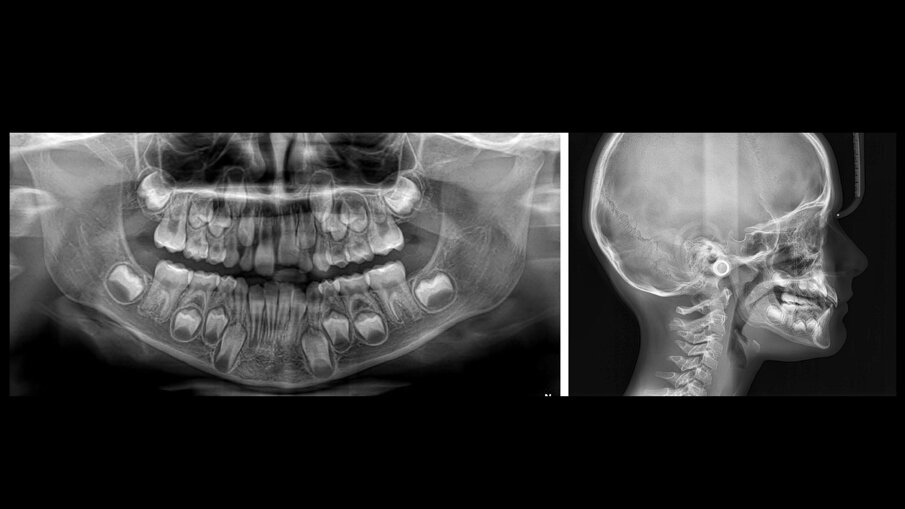 Fig. 2a-2b_Records radiografici pretrattamento.