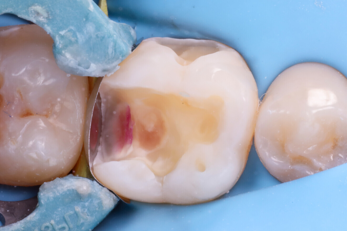 Fig. 7: Sectional matrix system in place.