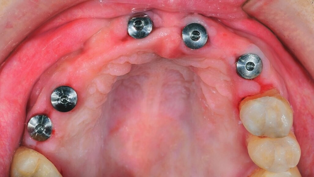 Predictable longevity of dental implants: high-quality evidence support