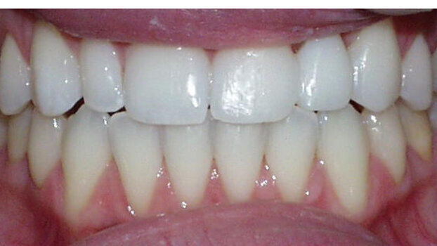 Solving esthetic dilemmas with direct composite bonding