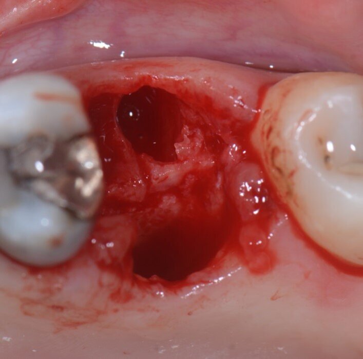 Fig. 3 -Alveolo post estrattivo.