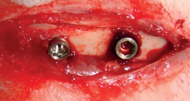 Histological and biomechanical effects of implant surfaces sandblasted with titanium dioxide microparticles: An experimental study using the rabbit tibia model