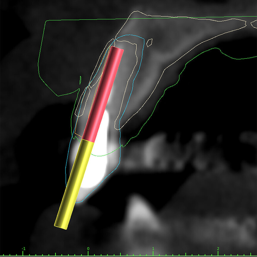 Fig. 3a: Planning the initial drill path using a custom implant design (red) to match the
diameter of the initial drill to reach the tooth apex. The abutment projection is shown in yellow.