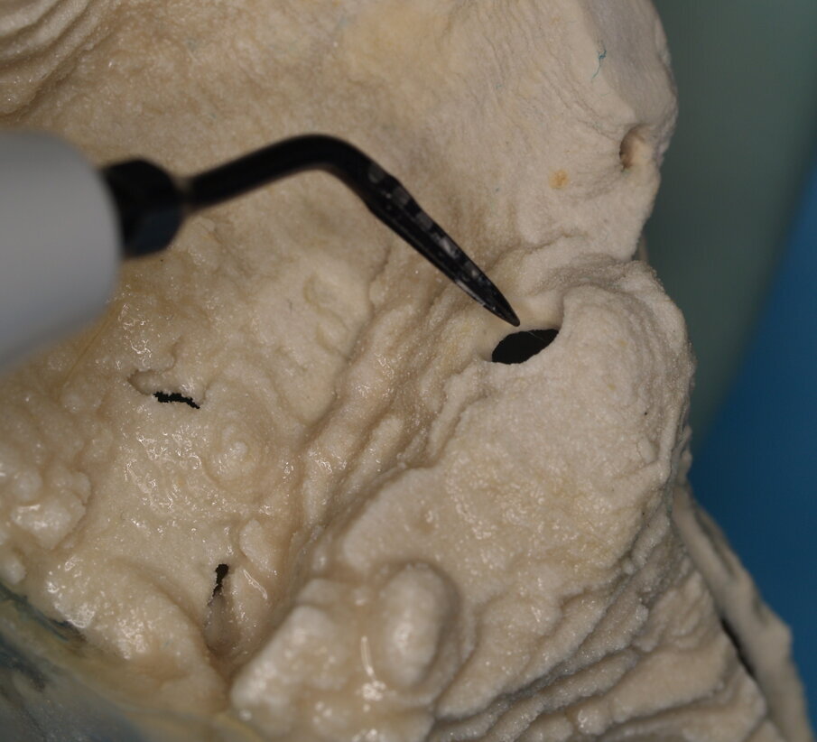 Figg. 6, 7 - Con l’inserto ES007T è possibile smussare gli angoli della preparazione.