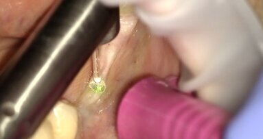 Odsłonięcie implantów przy użyciu lasera Er:YAG