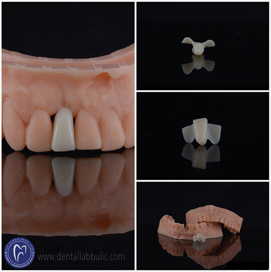 Slika 7: printani privremeni merilend most od biokompatibilnog hibridnog nano resina Temporis, 3D štampač DWS XFAB; Centar za dentalnu estetiku, dr Igor Ristić