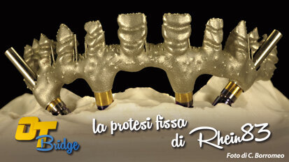 OT BRIDGE: la protesi fissa secondo la Rhein83