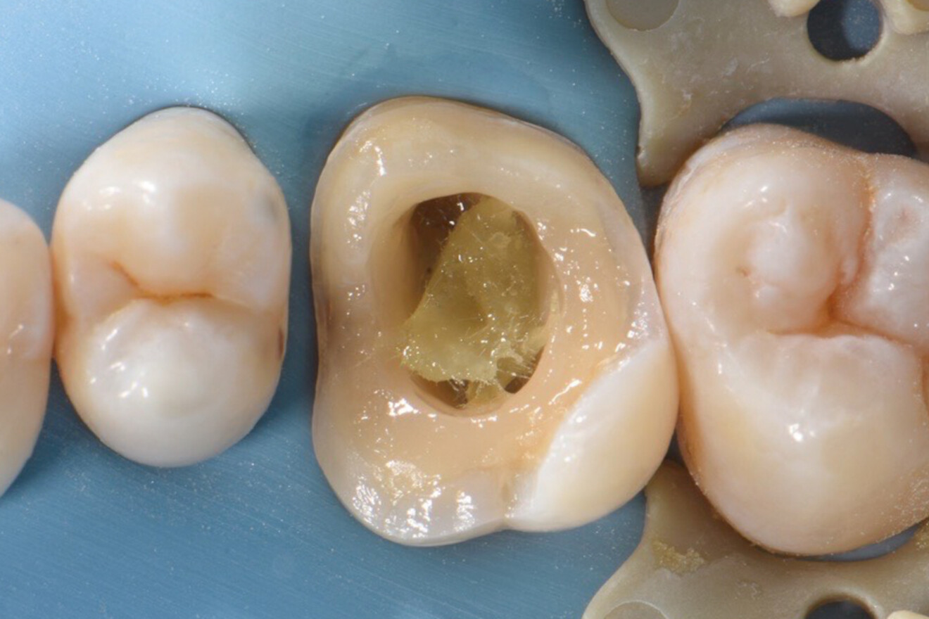 Fig. 22a: Placement of the short fibre-reinforced composite core.