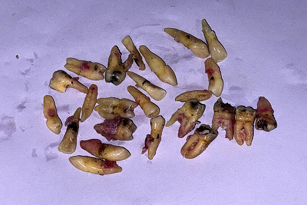 Fig. 10: Maxillary and mandibular extracted teeth.