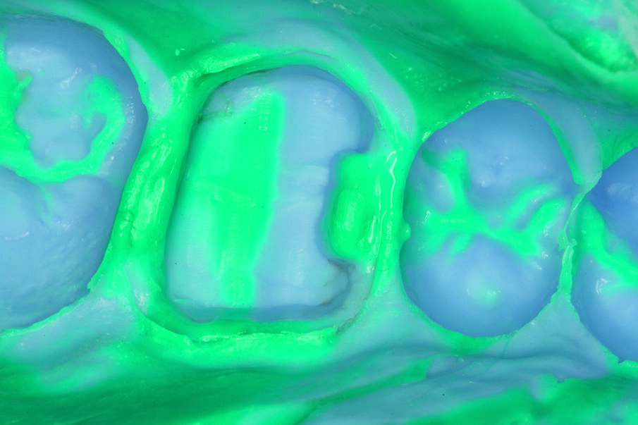 Fig. 7: Impression taking with Aquasil® Ultra Putty soft and Aquasil® Ultra Light LV.