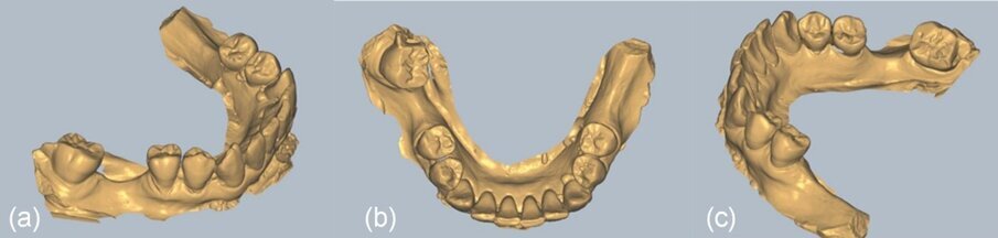 Fig. 17_a) fino a c): Viste del file STL nel software Exocad.