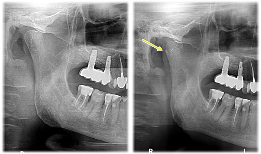 Ryc. 4_ Zdjęcie pantomograficzne przed urazem (po lewo) i po urazie (po prawo).