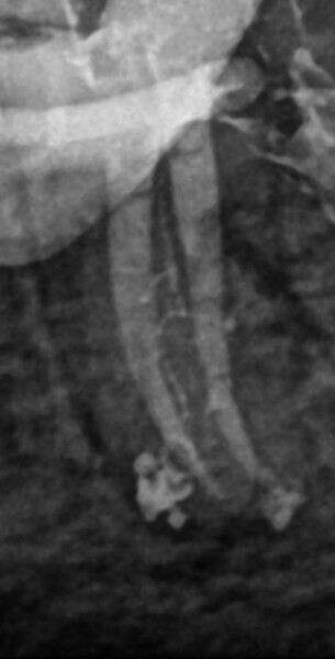 Fig. 35: Post-op radiograph, distal shift, showing a close-up of the mesial root with the filled isthmus.