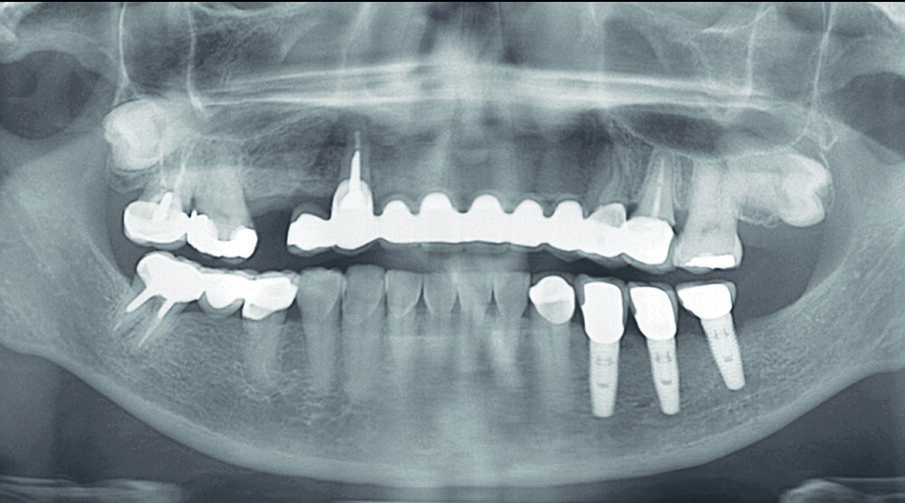 Fig 7. Pre-operative Panoramic XRAY