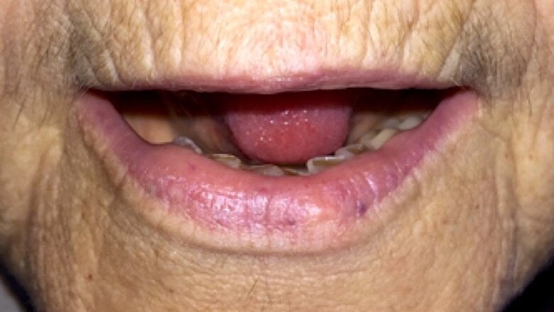 Fig. 5. Desaparición total de la lesión 3 meses después de la fotocoagulación.
