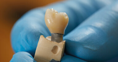 PANAVIA: 40 years of success in adhesive luting