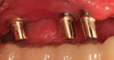 Study finds that shorter waiting time between procedures is adequate