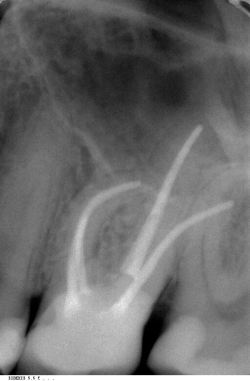 Fig. 7: Radiographic follow-up after two years.