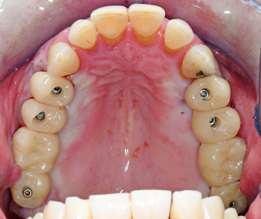 Obr. 4: Okamžité zatížení implantátů provizorními můstky.