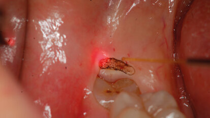 Il laser: perché e quando serve?