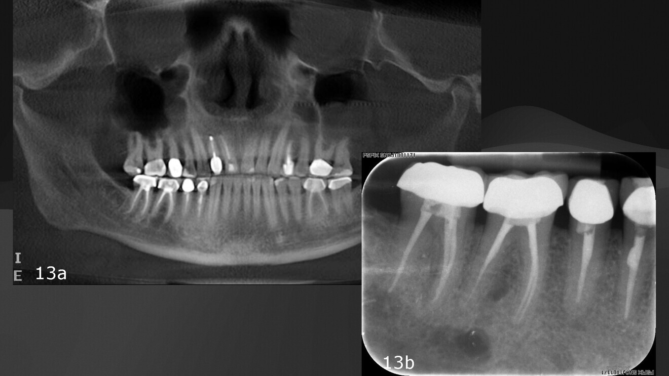Figs. 13a & b: Panoramic and periapical follow-up images showing a radiolucency under the mandibular right first molar.