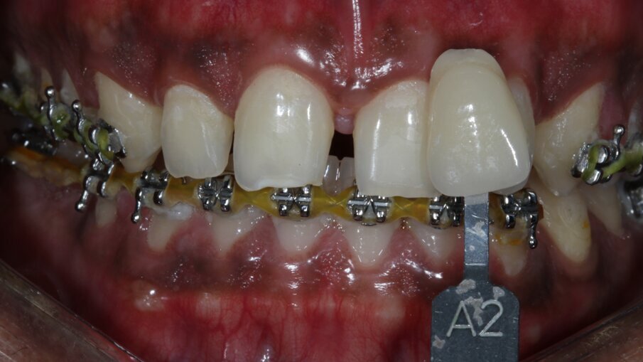 Fig 12: Shade selection