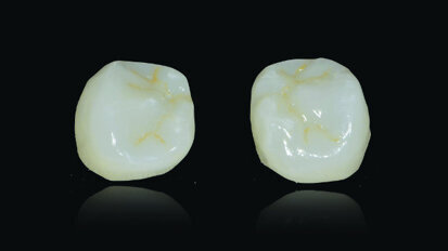 Restoring implants using lithium-disilicate,CAD/CAM fabricated restorations