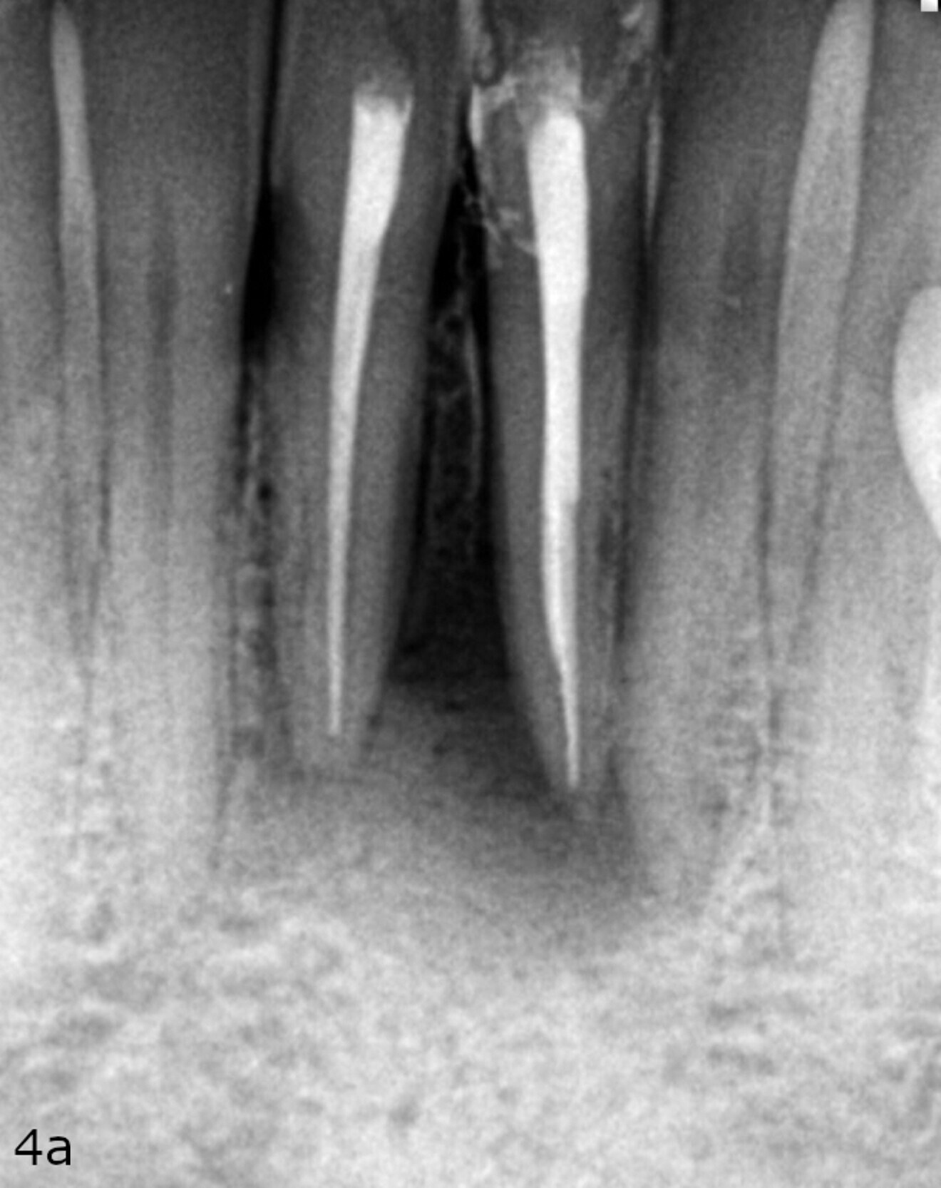 Fig. 4a: Radiographs showing the immediate post-op situation ... 
