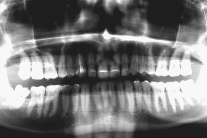 Fig. 4: Initial situation, panoramic radiograph (2015).