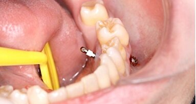 Intrusión de sectores posteriores con microimplantes