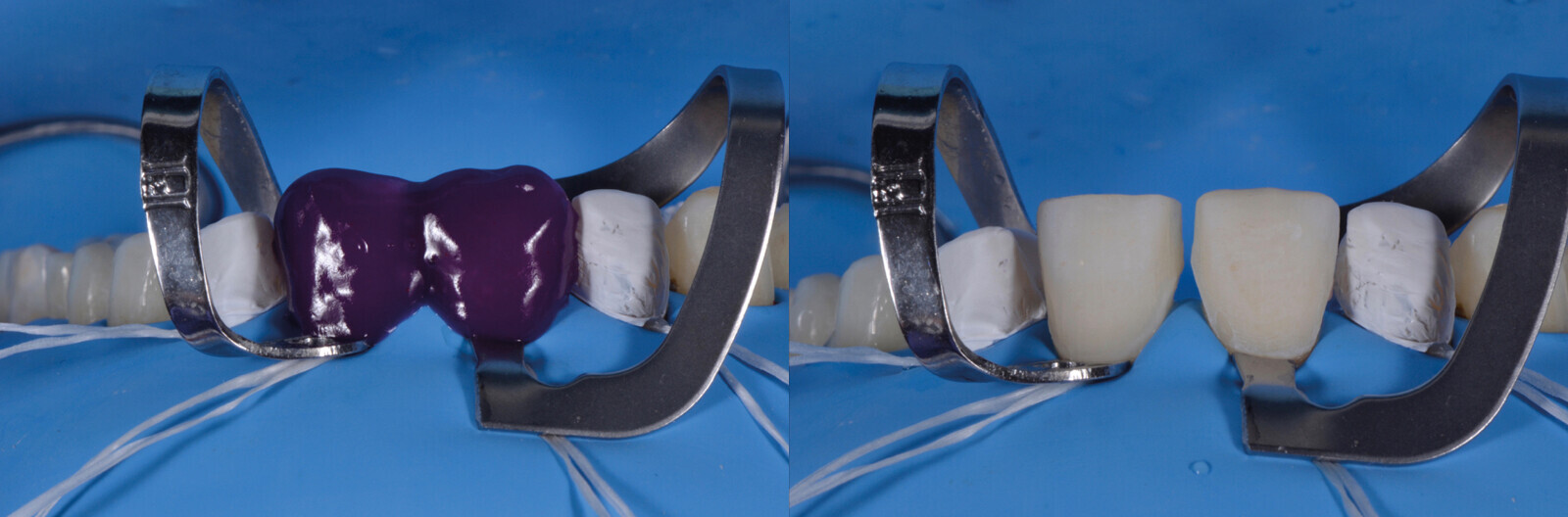 Fig. 16b. Grabado del esmalte durante 30 segundos con un ácido ortofosfórico al 32%.