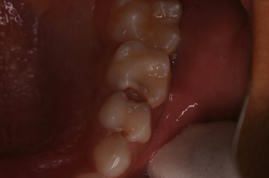 Afbeelding 5a. Onvoldoende toegankelijke caviteit mesiaal in de 65, distaal in de 64 en mesiaal in de 64. 