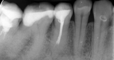 Zastosowanie lasera Er:YAG w procedurach udrażniania kanałów korzeniowych