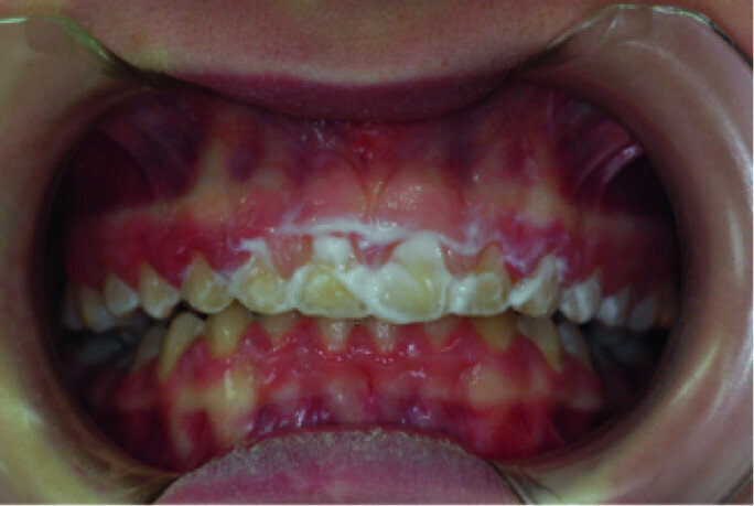 Application of a topical anaesthetic.
