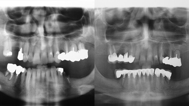 Dall’errata progettazione al fallimento del piano terapeutico ripercorrendo le criticità di un caso con l’odontologo forense