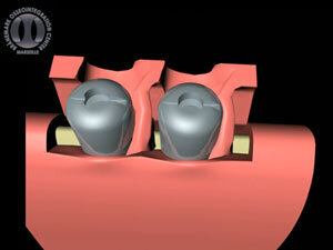 Papilla regeneration technique: The flap is retracted outward, the healing abutments placed on implants. Semilunar incision and rotation of the pedicles. The spaces between the pillars are filled by the pedicles, birth of new papillae.