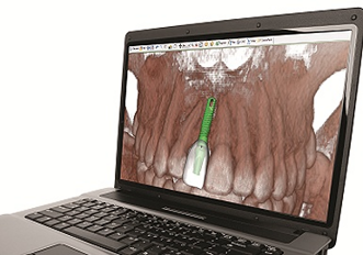 SimPlant 15 offers increased predictability SimPlant 15 offers increased predictability