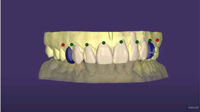 exocad – Diagnostic Waxup Model Creator Workflow