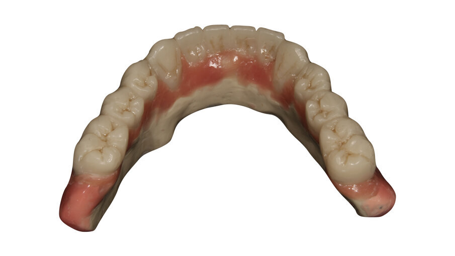 Figs. 15: Telescopic prosthesis with  BRILLIANT Crios restorations. Occlusal view.