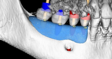 Horizontální augmentace hřebene a implantace: Dvoufázová procedura GBR