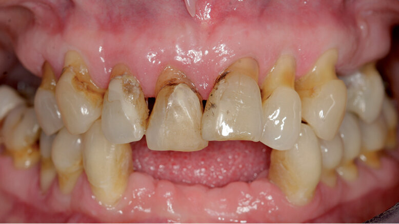 Zubní implantáty – od týmového plánování k esteticky úspěšnému výsledku