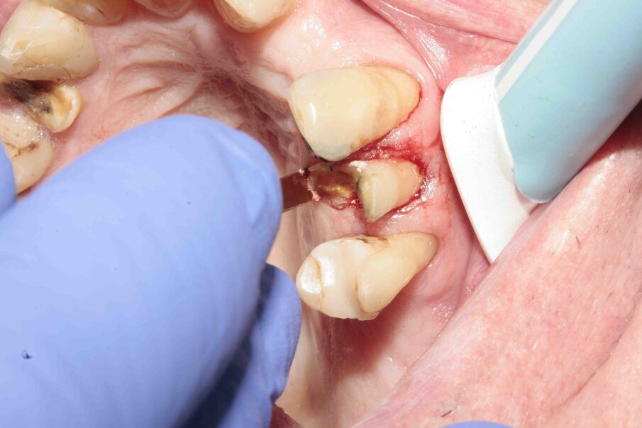 Figs. 5–7: Luxation was continued with Luxator P1 (straight blade, dark green).