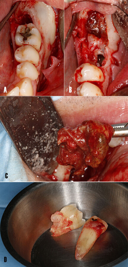 Figura 5. EnucleaciÃ³n del quiste. A) ElevaciÃ³n de colgajo mucoperiÃ³stico. B) ExtracciÃ³n del diente 3.6 afectado por la rizÃ³lisis debido al proceso osteolÃ­tico. C) Se procede a enuclear la parte mÃ¡s superficial de la lesiÃ³n. D) Dientes 3.5 y 3.6 tras la extracciÃ³n.