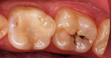 La gestion des caries profondes en technique Bio-Bulk Fill