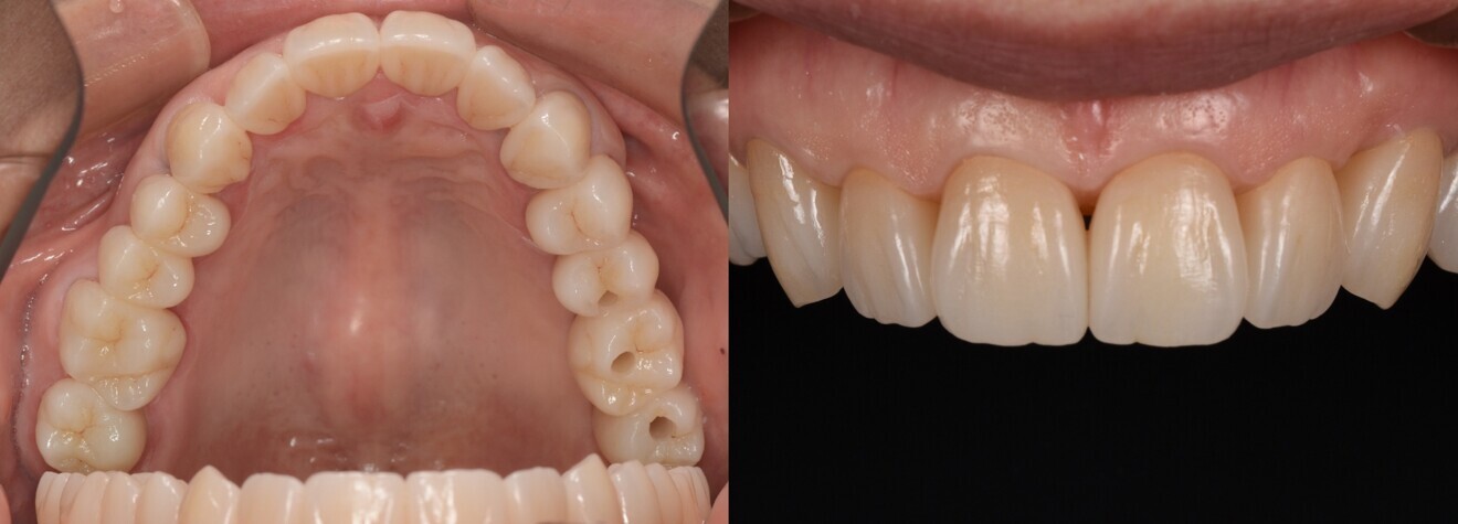 Figs. 10a & b: Highly aesthetic and functional result.