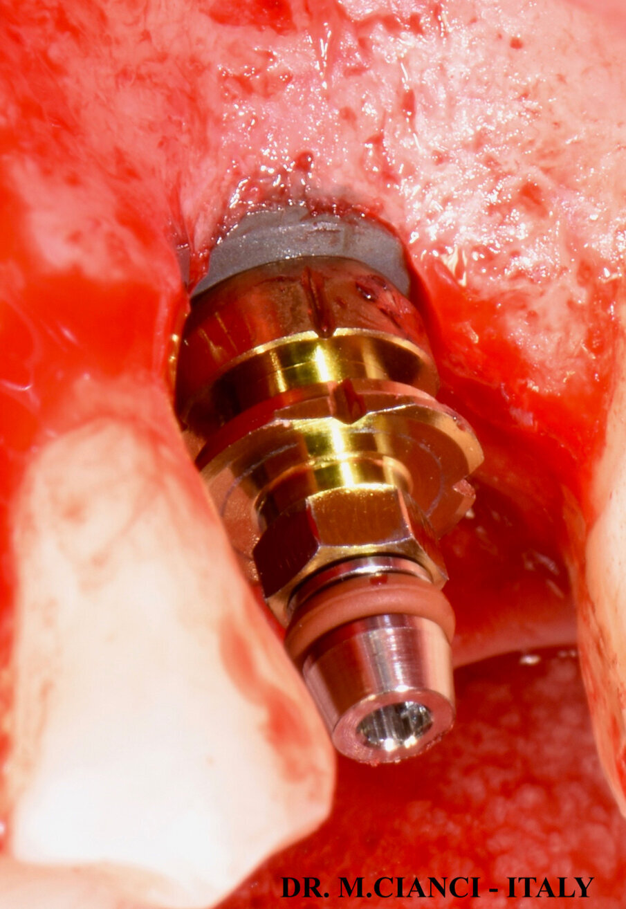 Fig. 7 - Versante vestibolare.